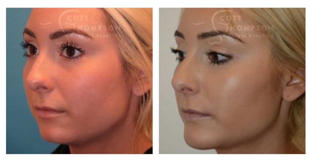 An introduction to chin implants and its benefits