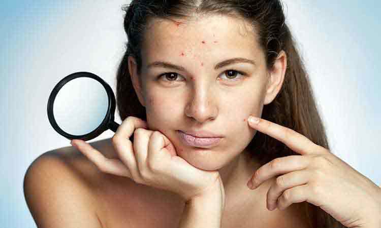 Know the causes of acne and its homeopathy treatment