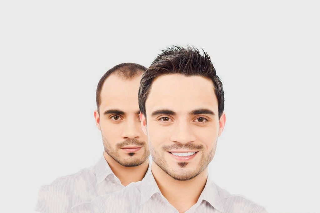 Take a look at Dhi Hair Transplantation Antalya