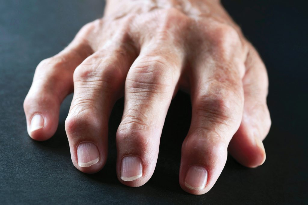 What is the first-line treatment for rheumatoid arthritis?