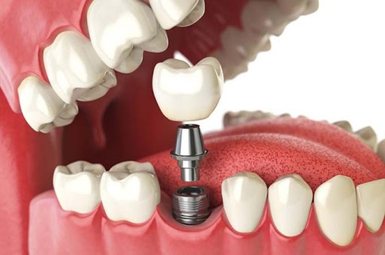 Dental Implants in Dubai: Costs, Procedure & How to Choose the Best Clinic