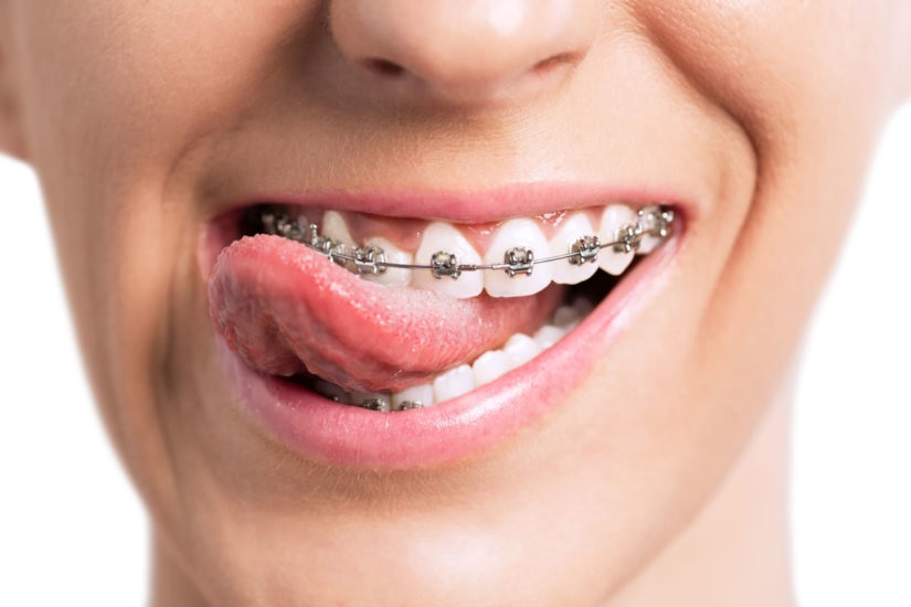 Get The Orthodontist You Need Fitness And Health Advisor