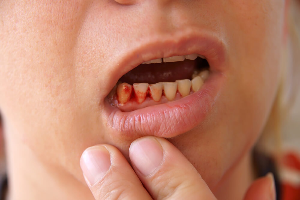 Bleeding Gums Causes Dos And Don ts And Treatment Fitness And 