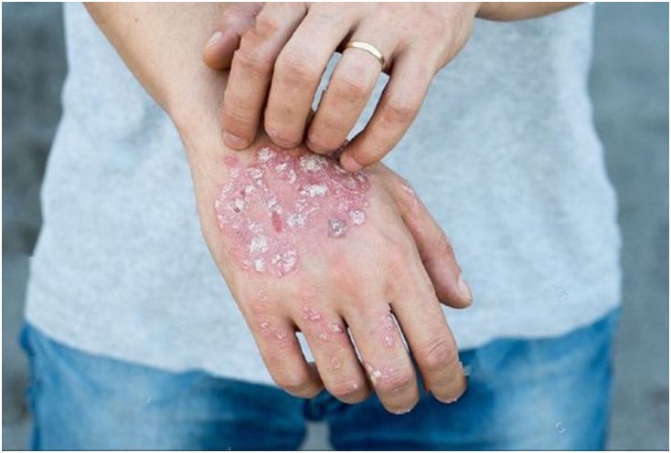 What Does Vascular Eczema Look Like? - Fitness And Health Advisor